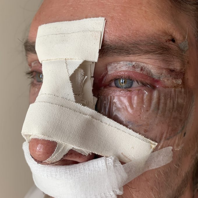 Facial Injuries and Disfigurement