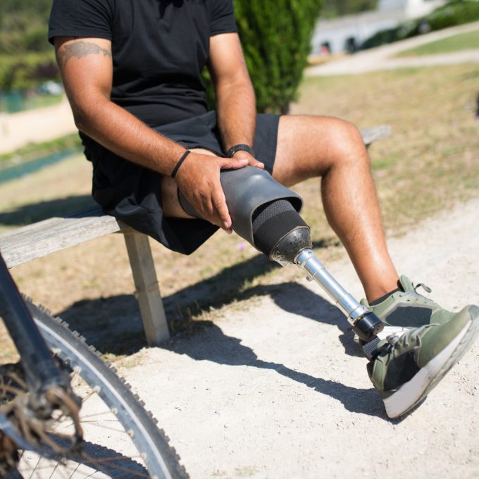 Limb Loss/Amputation Injuries