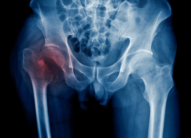 Serious Injury Claims